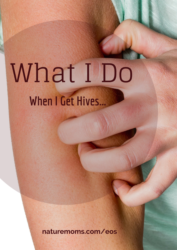 Do Hives Itch - About hives