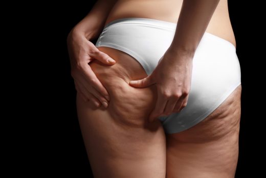 Natural Ways to Fight Cellulite